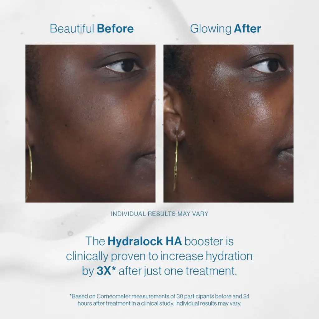 before and after images of hydration technology used on a woman