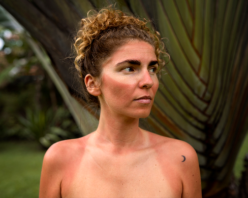 woman with sunburned skin
